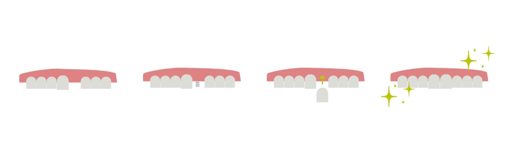 the dental implant process in Midhurst, West Sussex