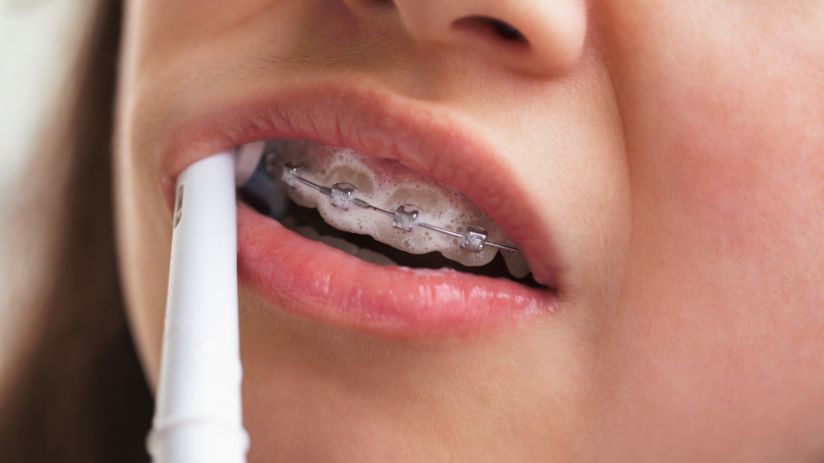 girl brushing her braces with toothpaste